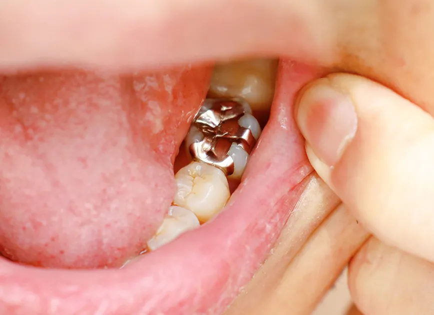 水銀を含む保険金属「アマルガム」