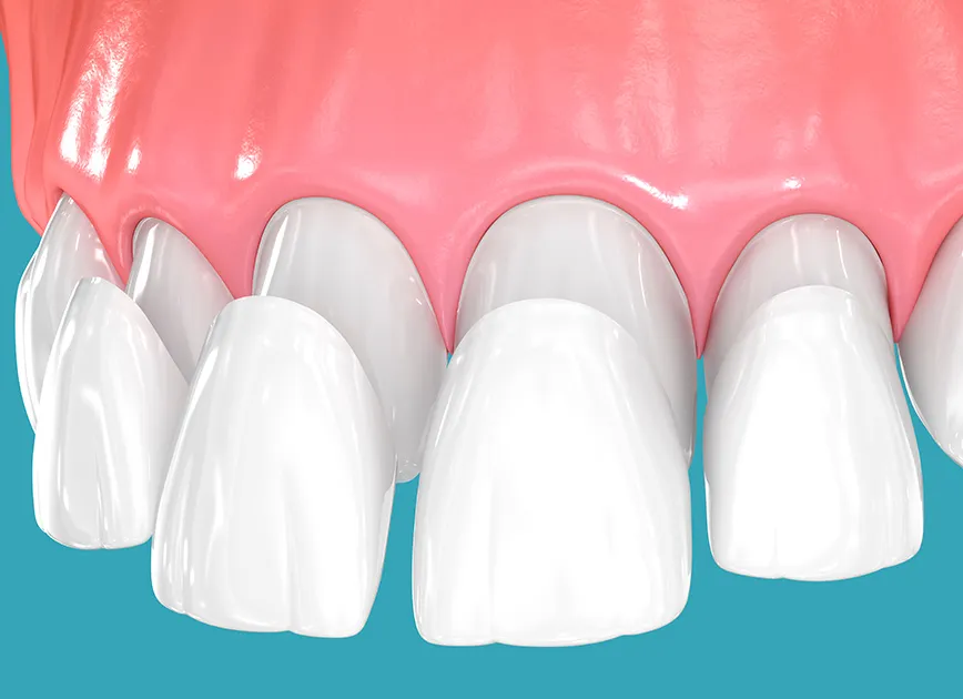 01. 歯の表面に薄いセラミックを貼り付ける方法