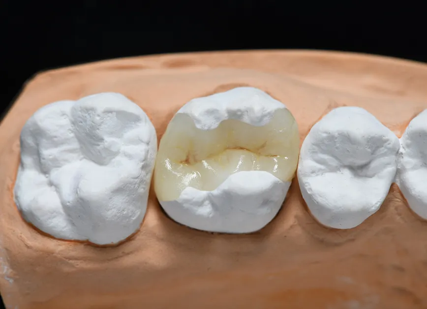 02. 歯の一部分にセラミックを詰める方法