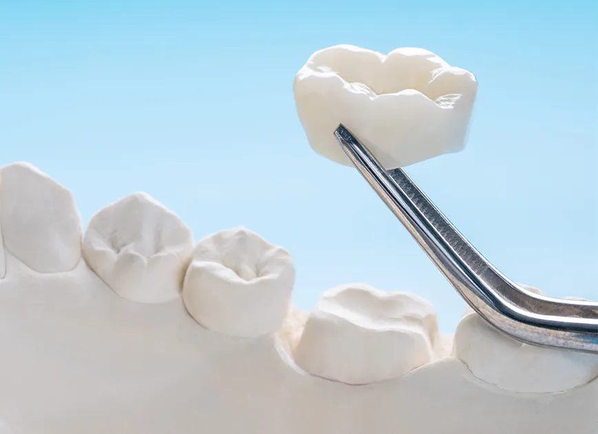 03. 歯全体にセラミックを被せる方法