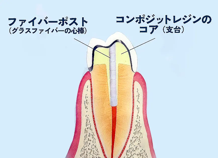 被せ物をするための土台(ファイバーコア)