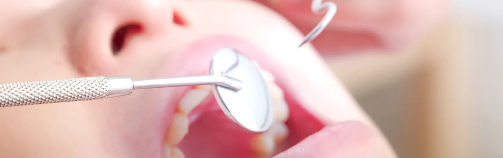 虫歯ができる仕組み