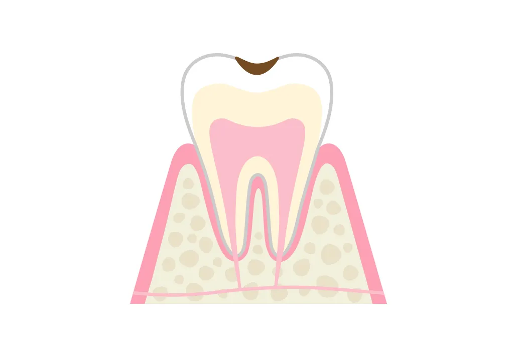 C1 歯の表面(エナメル質)の虫歯