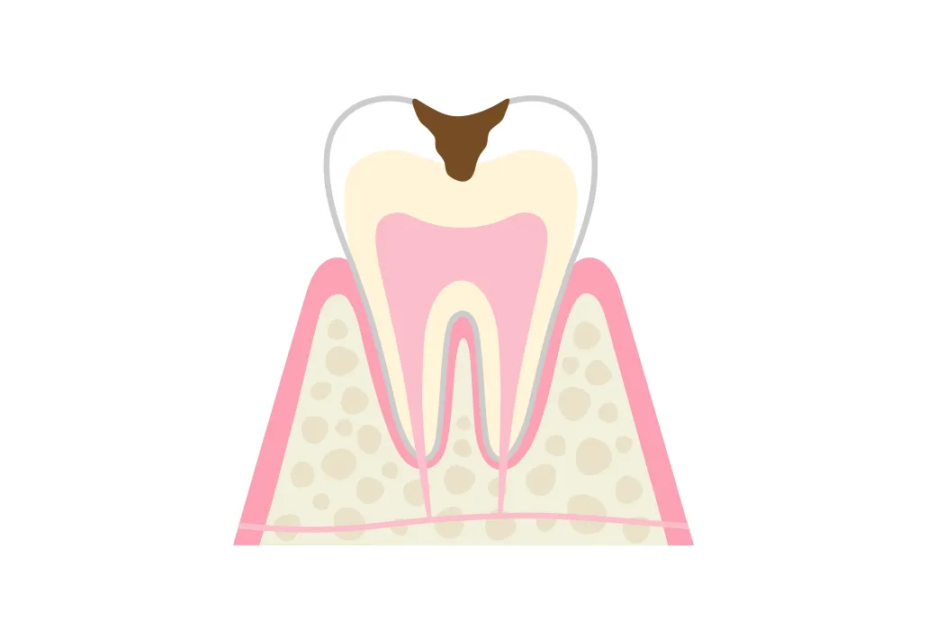 C2 歯の中(象牙質)の虫歯