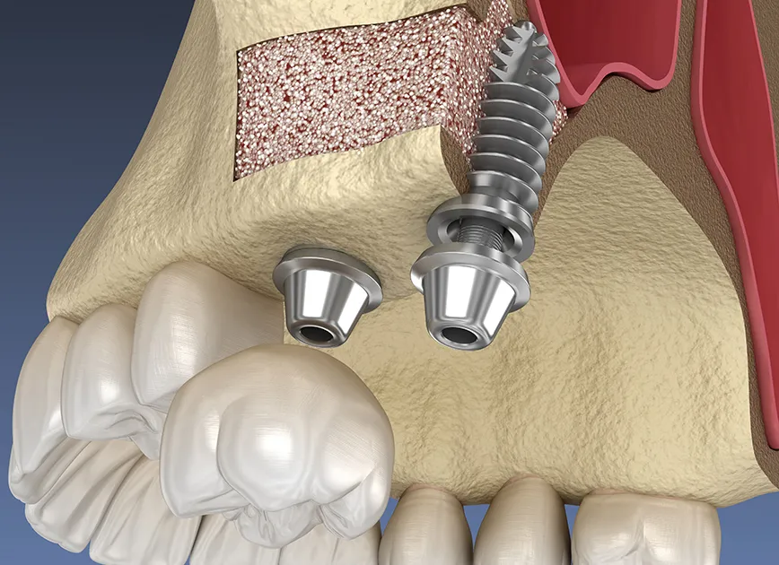 サイナスリフト（上顎洞底挙上術）とは