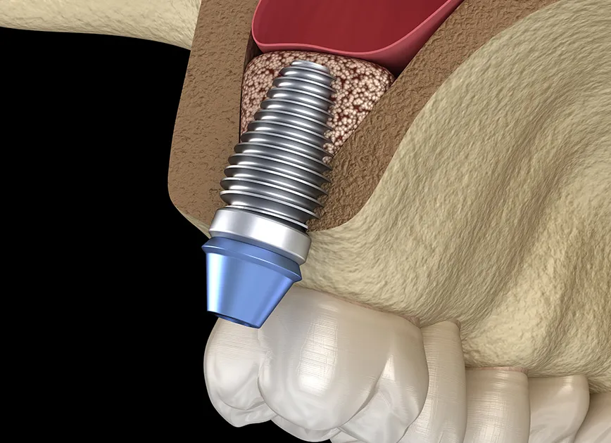 ソケットリフトとは