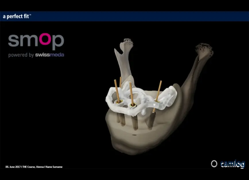 サージカルガイドとは