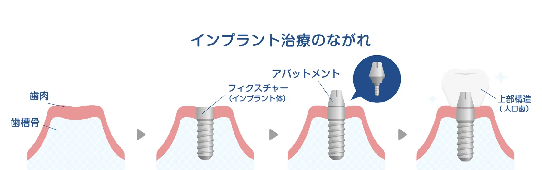インプラント治療の流れ