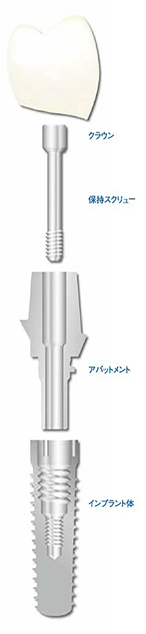 インプラントとは?