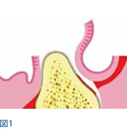 インプラントとは?