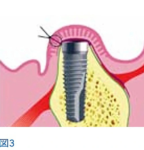 インプラントとは?