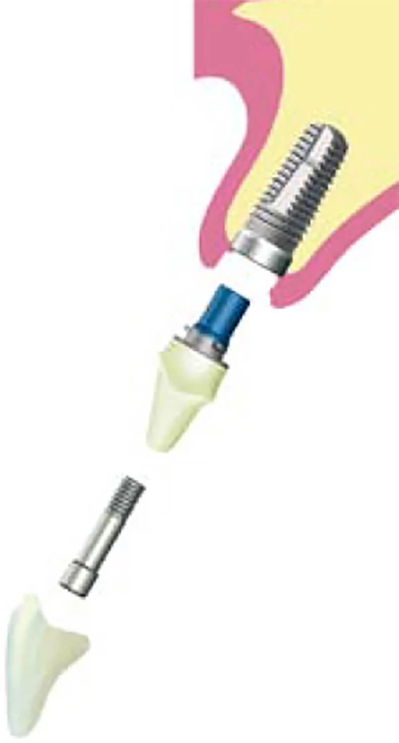 歯が一本だけ欠損している場合。