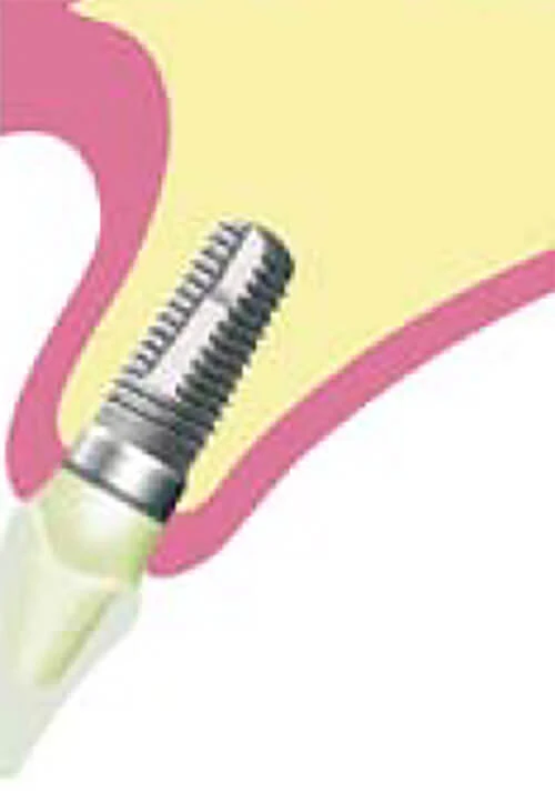 歯が一本だけ欠損している場合。