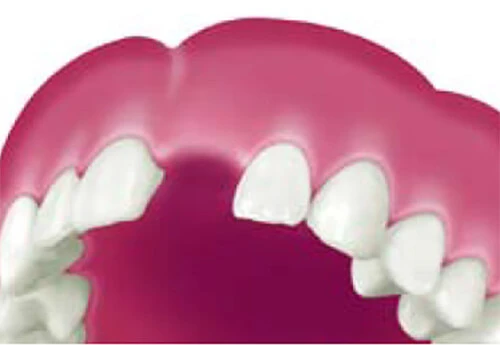 歯が一本欠損した状態。