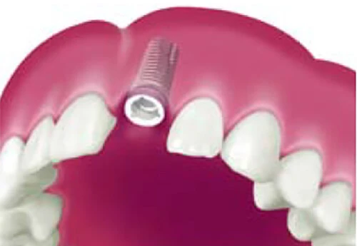 インプラントが骨の中で治癒した状態。