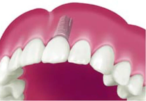 クラウン(歯冠)で修復された状態。