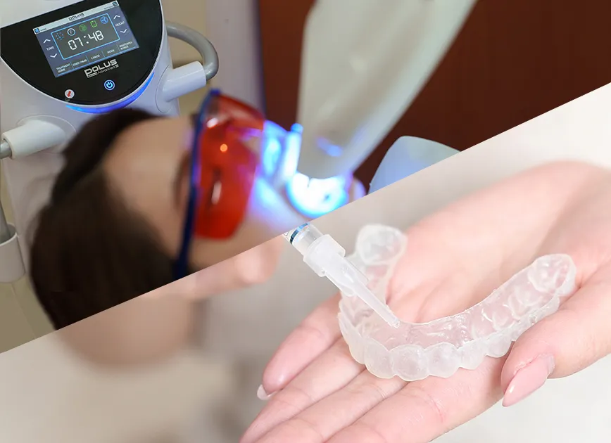 ホームホワイトニング