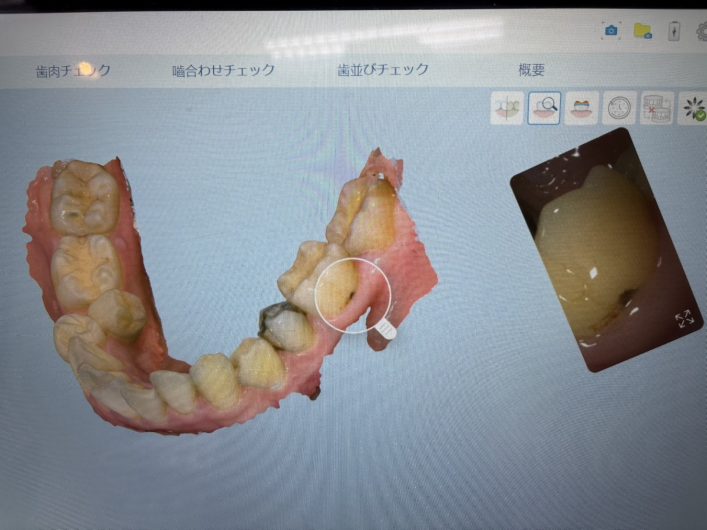 口腔内スキャナー