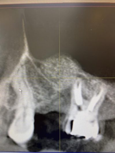サイナスリフトによる骨造成