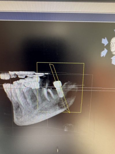 奥歯のインプラント治療
